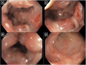 Colonoscopy. (A) Ulcers and pseudopolyps in the mucosa are observed, along with abundant mucus. (B) The reduced lumen is passable and there is inflammation and edema of the mucosa. (C) Signs of bleeding and fibrinopurulent material can be observed. (D) Multiple ulcers smaller than 5 mm, with well-defined 3-5 mm edges, are shown.