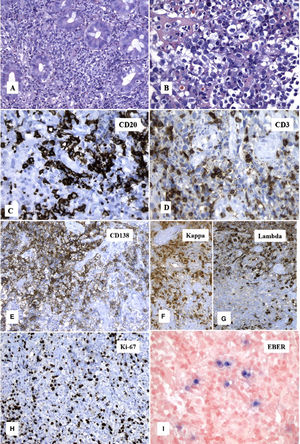 Biopsy of the rectal lesion and immunohistochemistry. Periglandular lymphoid infiltrate (A and B) made up of a mixture of B lymphocytes positive for CD20 (C) and T lymphocytes positive for CD3 (D). The lymphoid infiltrate also presented with abundant plasma cells that were polyclonal (E) and expressed both Kappa (F) and Lamda (G) light chains. The proliferation index measured with Ki-67 was 10% (H) and there was multifocal positivity to the in situ hybridization for Epstein-Barr virus (Epstein-Barr encoding region [EBER]) (I).