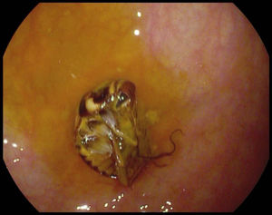 Cockroach in the right-sided colon.