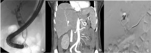 (a) Initial cholangiography, documenting multiple gallstones. (b) CT angiography showing the pseudoaneurysm in the left hepatic artery. (c) Super-selective coil embolization of the pseudoaneurysm in the hepatic artery.