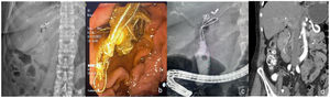 (a) Preliminary x-ray showing the partial migration of the embolization material into the bile duct and duodenum. (b) Endoscopic evidence of the vascular embolization metallic material in the duodenum. (c) Cholangiographic image of the gallstone associated with the material that migrated into the bile duct. (d) CT angiography ruling out flow to the level of the pseudoaneurysm after the partial migration of the material into the bile duct and up to the fourth part of the duodenum.