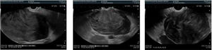 Diagnostic echoendoscopy with FNP.