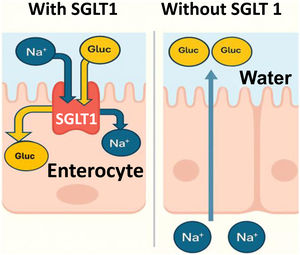 a) SGLT 1 transporter: It carries out the active transport of glucose and galactose in the enterocyte against a concentration gradient, from the intestinal lumen into the enterocyte. The energy required for making this transport possible is acquired from sodium cotransportation in the same direction. b) absence of the SGLT 1 transporter: When glucose and galactose are not absorbed, these sugars remain in the intestinal lumen and draw water out due to the osmotic effect, leading to osmotic diarrhea and severe dehydration.3 The net result is a greater loss of water than sodium, and in turn, sodium becomes concentrated in the plasma, resulting in hypernatremia.