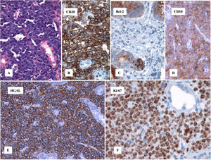Histopathologic studies of the infiltrated gastric mucosa due to Burkitt lymphoma. A) Hematoxylin and eosin staining. B) Positive for CD20. C) Negative for Bcl-2. D) Positive for CD10 (CALLA). E) Positive for HGAL. F) Ki-67 proliferation index of 95%.