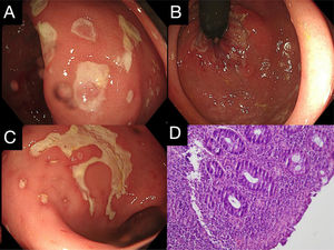 (A–C) Rectal ulcers with well-defined geographic borders covered by fibrin. Their sizes vary, with the largest measuring 7 mm in length. (D) Superficial ulceration with a moderate mixed inflammatory infiltrate, predominantly acute, composed of polymorphonuclear cells, associated with cryptitis (H&E).