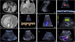 Selected radiologic findings. (A) Contrast-enhanced CT in the venous phase showing chronic portal vein thrombosis with multiple collateral vessels at the hepatic hilum. (B) Coronal contrast-enhanced CT in the portal phase showing a patent portal vein and smooth hepatic surface. (C) Ultrasound showing splenomegaly. (D) Doppler ultrasound revealing slow flow. (E) Venous-phase CT showing hypertrophy of the caudate lobe. (F and G) Doppler ultrasound of the hepatic veins showing loss of normal triphasic pattern. (H) Two-dimensional shear-wave elastography (2D-SWE) showing normal liver stiffness. (I–K) B-mode ultrasound demonstrating thickening of the portal vein wall. (L) B-mode ultrasound showing a markedly dilated splenic vein.