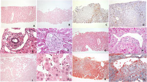 Illustrative liver biopsy findings. (A and B) Nodular regenerative hyperplasia with irregular nodular parenchyma and large hepatocytes forming nodules, surrounded by atrophic cells (H&E 40× and 20×). (C and D) Pericentral collapse and nodular pattern of the parenchyma; atrophic hepatocytes positive for CK7 and nodular regeneration, with sinusoidal CD34 expression (20× and 40×). (E) Irregular portal tracts with sclerosis and partial stenosis (H&E 400×). (F) Obliterative portal venopathy with marked portal vein stenosis (PAS 400×). (G) Incomplete septal fibrosis with sinusoidal dilation and loss of portal venules (H&E 40×). (H) Portal herniation with aberrant vessels in direct contact with hepatocytes (PAS 200×). (I) Sinusoidal dilation with endothelial prominence and a spongiform pattern in zones 2 and 3 (H&E 40×). (J) Lymphocytic margination and apoptotic debris within sinusoids (H&E 400×). (K and L) Bridging fibrosis (incomplete septal fibrosis), with multiple thin-walled vascular structures, megasinusoids, and periportal phlebosclerotic changes (Masson 40× and 400×).