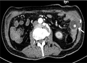Axial computed tomography scan confirming the migrated gastrostomy Foley catheter.