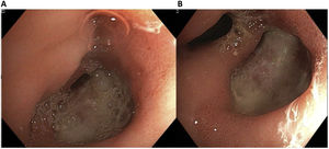 A) Antral ulcer adjacent to the pylorus and measuring approximately 3 cm, deforming its opening. B) The ulcer presented with a perforation bordering the pylorus that enabled the passage of the instrument (double lumen).