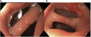 A) Isolated erosions in the mucosal septum. B) Mucosal septum creating two openings into the duodenum – the double pylorus sign.
