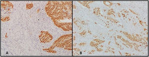 Nuclear staining of SOX9 in the colon with high and low expression determined through the H-score. (A) High nuclear SOX9 expression (H-score ≥ 145). (B) Low nuclear SOX9 expression (H-score ≤ 144). Photomicrographs of the colon showing nuclear SOX9 antibody expression. Image A is an example of high nuclear marking and image B is an example of low nuclear expression.