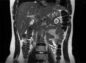 Coronal view of the MRI scan with intravenous contrast in T2, showing a cystic lesion with regular edges, with blood debris in its interior, as well as a “fish-tail pancreas” bifid morphology.
