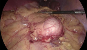 Laparoscopic intraoperative image, showing the cystic lesion with regular edges and no signs of macroscopic invasion.