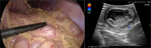 Intraoperative ultrasound showing an anechoic lesion with regular edges and negative Doppler shift. The sonographic layer of the wall is similar to that of the intestinal wall and there are no signs of vascular invasion or invasion into the adjacent parenchyma. The data are consistent with pancreatic duplication cyst.
