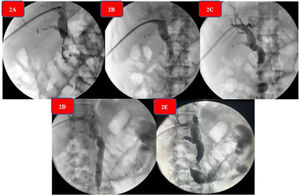 (A–E) Percutaneous cholangiography sequence. (A) Permeability of the percutaneous transhepatic drain. (B) Hydrophilic guidewire in the duodenum. (C) Introduction of the cholangioscope and electrohydraulic lithotripsy. (D) Anterograde sphincteroplasty. (E) Control cholangiography.