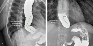 Esophagograms corresponding to the patients in Fig. 1 (panel A) and Fig. 2 (panel B), which according to the radiologic classification of achalasia, are consistent with a non-advanced sigmoid esophagus (α ≥ 90° to <135°) and a straight esophagus (α ≥ 135°)2: the esophageal tortuosity (A) was associated with failed cannulation, whereas the right angle (B) enabled adequate cannulation.
