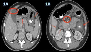 A and B) abdominal tomography scan showing gastric antral, duodenal, and colonic splenic flexure thickening, with para-aortic and mesenteric adenomegaly and free intra-abdominal fluid.