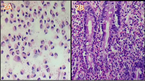 A) ascitic fluid cytology (eosinophils 70%; neutrophils 10%; lymphocytes 3%; histiocytes 6%; plasmacytes 1%; and mesothelial cells 10%), with no malignant cells. B) duodenal histopathology image showing focal villous atrophy and countless eosinophils, with glandular epithelium permeability.