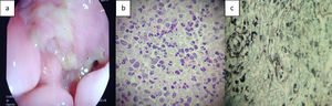 a) the presence of ulcers in the sigmoid colon, b) the pathologic anatomy study with hematoxylin-eosin staining revealed multiple purple, sphere-shaped microorganisms, surrounded by a whitish halo, consistent with histoplasmosis, and c) Gomori staining showed the presence of multiple microorganisms consistent with mycosis.