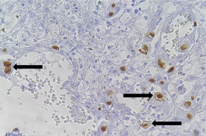 Immunohistochemistry (×20). Nuclear inclusions with a perinuclear halo, characteristic of CMV (arrows).