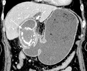 A coronal CT scan shows the impacted stone (arrow) in the first portion of the duodenum and the marked gastric distension. A coronal CT scan shows the impacted stone (arrow) in the first portion of the duodenum and the marked gastric distension.