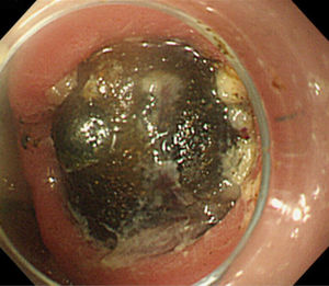 Endoscopic appearance of the impacted gallstone in the first portion of the duodenum, resulting in complete gastric outlet obstruction. Endoscopic appearance of the impacted gallstone in the first portion of the duodenum, resulting in complete gastric outlet obstruction.