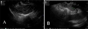 (A) Body and (B) tail of the pancreas with minor Rosemont criteria for chronic pancreatitis9,10) (hyperechoic traces with no acoustic shadow and hyperechoic enhancement of the walls of the main pancreatic duct).