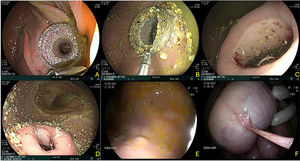 Gastroenteric anastomosis using the direct technique. A) Initial Hot AXIOS™ placement. B) Stent removal at day 30. C and D) Anastomosis status immediately after stent removal. E and F) Final evaluation at day 60, showing total gastroenteric anastomosis closure on the gastric mucosa side and the presence of the omentum adhered to the anastomosis site.