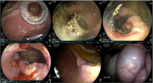 Gastroenteric anastomosis using the linear cutting technique. A) Initial Hot AXIOS™ placement. B and C) Gastroenteric anastomosis evaluation at day 15, carrying out linear cutting with clip use at the edges. D) Supportive stent removal at day 30 and gastroenteric anastomosis status evaluation. E and F) Final evaluation at day 60, showing a luminal mucosal scar, and on the extraluminal side, a scar at the level of the gastroenteric anastomosis and remnants of the omentum.