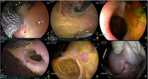 Gastroenteric anastomosis using the absolute ethanol sclerotherapy technique. A and B) Initial Hot AXIOS™ placement with absolute ethanol application around and inside the stent. C and D) Endoscopic view and gastroenteric anastomosis status in both models at day 30. E and F) Final evaluation at day 60, showing a prepyloric luminal scar in the anastomosis region and gastric-omentum-enteral adherence on the extraluminal side.