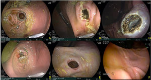Gastroenteric anastomosis using the argon plasma coagulation technique. A) Initial Hot AXIOS™ placement. B and C) Argon plasma application on the gastroenteric anastomosis at 15 days. D) Gastroenteric anastomosis and support stent at day 30. E) Gastroenteric anastomosis status after Hot AXIOS stent removal. F) Final evaluation at day 60, showing complete closure at the level of the previous gastroenteric anastomosis site.