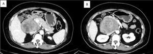 A and B. Abdominal CT with intravenous contrast: heterogeneous retroperitoneal lesion measuring 81 × 75 × 66 mm that is contiguous with the second part of the duodenum; the head of the pancreas is displaced, and the inferior vena cava is partially compressed.