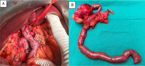 A) Surgical field. B) Definitive specimen (cephalic duodenopancreatectomy with en bloc resection of the IVC).