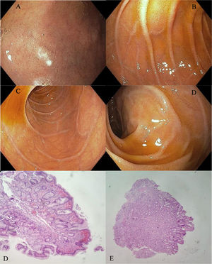 Esophagogastroduodenoscopy images. A) Duodenal bulb (D1), with endoscopic changes suggestive of villous atrophy during the immersion maneuver. B and C) Villous flattening in D2. D) Moderate flattening of the villi in D3. E) Histopathology reporting mild villous atrophy and the presence of CD3/CD8 intraepithelial lymphocytes of 50% (Marsh 3A). Source: Patient’s clinical history.