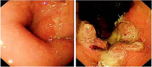 Initial endoscopy with no apparent tumor (A) and then endoscopy at 21 months (B) with ulcerated squamous cell carcinoma.