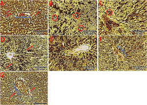 (A–G) Representative light microscopy micrographs of liver sections with Gridley’s silver impregnation staining, showing reticulin fibers forming a delicate meshwork in the space of Disse (red arrow) and portal areas (blue parenthesis) outlined in A, D, F, and G and accentuated in B and C with thickened, collapsed, lumpy, and fragmented reticulin fibers (red circle). A less thickened, collapsed reticulin meshwork is seen in E. Scaling bars – 50 μm.