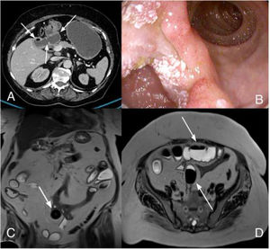 A) Contrast-enhanced axial abdominal CT image, showing the cholecystoduodenal fistula (lower arrow) that connects the gallbladder (upper left arrow) to the duodenum (upper right arrow). B) Large wall defect at the level of the inferior surface of the duodenal bulb, corresponding to the cholecystoduodenal fistula, seen through the forward-viewing gastroscope. The coronal view of the MRE image in the T2-weighted sequence with no fat suppression, shows C) the ectopic gallstone impacted in the jejunal segment. Axial T2-weighted sequence with no fat suppression shows D) small bowel segment dilation (upper arrow) secondary to the ectopic gallstone impacted in the jejunum (lower arrow).
