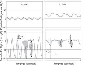 Registros simultâneos das pressões faríngea (em cima) e esofágica (embaixo) de bebês que recebem 1 L/min (esquerda) e 7 L/min (direita) por meio de cânula nasal. Embora ocorra um aumento considerável na pressão faríngea durante condições de fluxo mais alto, praticamente nenhum aumento é observado na pressão expiratória final medida em nível torácico. A aplicação de um fluxo de 7 L/min reduziu de forma significativa as oscilações da pressão intratorácica por meio da atenuação da pressão inspiratória negativa. Adaptado de Milési et al.15