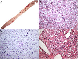 Aspectos histológicos da biópsia de fígado no paciente 7. A – Fibrose em ponte marcada com nódulos ocasionais (coloração com Picrosirius Red, 25X); B – Esteatose mediovesicular (variante de pequenas gotículas da esteatose macrovesicular) e hepatócitos com citoplasma pálido (H&E, 400X); C – Somente raras células de Kupffer microvacuoladas foram identificadas, que foram ligeiramente coradas com PAS (PAS após digestão diastásica, 400X); D – Alguns macrófagos com citoplasma espumoso e corado foram detectados nos tratos portais (H&E, 400X).