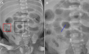 A, radiografia abdominal mostra aumento da espessura da parede intestinal (BWT, do inglês Bowel Wall Thickening) e alça normal circunscrita pela caixa preta e caixa vermelha, respectivamente; B, linha do BWT, perpendicular à parede do intestino, identificada pelo radiologista.