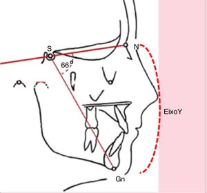 Eixo Y de crescimento facial (representado pela abertura do ângulo NS‐Gn).