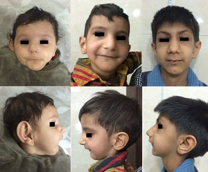 Visão facial ampliada e lateral de três casos de síndrome de Sanjad‐Sakati confirmados geneticamente. Observação: Orelhas baixas com grandes lóbulos flexíveis, micrognatismo e nariz bulboso ou de bico.
