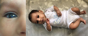 Neonato de quatro meses com síndrome de Sanjad‐Sakati (confirmada por estudo molecular) encaminhado devido ao crescimento deficiente. Observação: Constatamos hipocalcemia assintomática e catarata bilateral que indicaram hipoparatireoidismo.