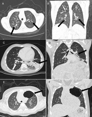 Paciente do sexo masculino, oito anos. Imagens de TC axial (A) e coronal (B) com ultrabaixa dose demonstraram bronquiectasias cilíndricas (centrais) peri‐hilares (setas), sugestivas de fibrose cística. Imagens de TC axial (C) e coronal (D) com ultrabaixa dose mostram um caso de uma criança do sexo masculino de três anos com espessamento da parede brônquica (seta branca) e atelectasia no lobo inferior esquerdo (seta preta), sugestivo de bronquiolite obliterante. Imagens de TC axial (E) e coronal (F) com ultrabaixa dose demonstraram malformação congênita pulmonar das vias aéreas de tipo I no lobo superior esquerdo (seta) – Malformação adenomatoide cística pulmonar – em uma criança do sexo feminino de cinco anos.