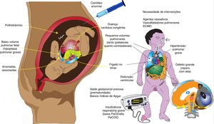 Fatores associados ao prognóstico ruim da hérnia diafragmática congênita (HDC). Fatores pré‐natais, como baixo volume pulmonar fetal, anomalias associadas (especialmente cardíacas), polihidrâmnio, cariótipo anormal e fígado localizado no tórax podem estar associados a menor sobrevida. Fatores pós‐natais associados à hipertensão pulmonar grave (baixa PaO2), hipoplasia pulmonar (alta PaCO2), grande defeito que requer reparo com tela, disfunção ventricular e necessidade de agentes vasoativos e/ou ECMO, estão associados a maior mortalidade. Direitos autorais: Satyan Lakshminrusimha.