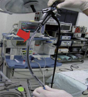 Placement of the tube on the fiber optics before the start of the procedure. The tube connector is removed and set aside in a safe place, in order to ease passage through the mask.