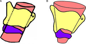 Adult (A) and pediatric larynx (B). The glottic aperture is the narrowest portion of the adult larynx, whereas this portion is found at the level of the cricoid cartilage in the infant.