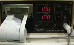 Electromyograph. Relaxograph NMT Monitor (Datex Instrumentarium Corp., Helsinki, Finland). Recording strip with real time TOF. Source: Authors.