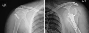 Shoulder X-ray. D: right; I: left.