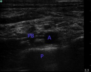 Supraclavicular block. PB: brachial plexus; A: artery; P: pleura.